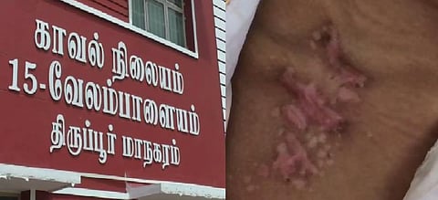 அபூர்வ மூலிகை என ஆசிட் கொடுத்த போலி மருத்துவர் : கடுமையாக பாதிக்கப்பட்ட சிறுமி