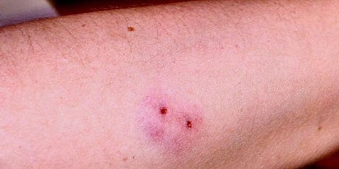 பள்ளியில் விளையாடும் போது சிறுவனை பாம்பு கடித்ததா ? - கேரளாவில் மற்றொரு சம்பவம்