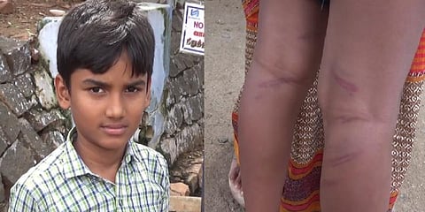 இரக்கமின்றி பிரம்பால் அடித்த ஆசிரியர் : 4-ஆம் வகுப்பு மாணவர் மருத்துவமனையில் அனுமதி