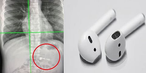 கிறிஸ்துமஸ் அன்பளிப்பாக வந்த Airpodஐ விழுங்கிய 7வயது சிறுவன்!