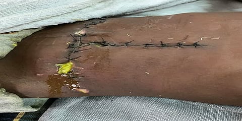 ‘ஒரு ரூபாய் செலவில்லாமல் சிறுவனக்கு அறுவை சிகிச்சை’ - வியக்க வைத்த மருத்துவரின் ஃபேஸ்புக் பதிவு