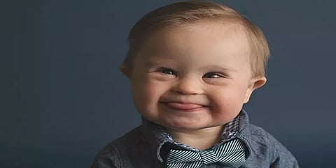 இன்று உலக டவுன் சிண்ட்ரோம் தினம்...!