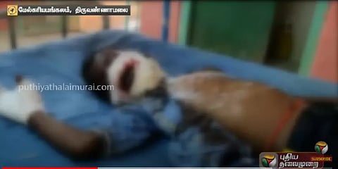 சமூக விரோதிகள் வைத்த நாட்டு வெடிகுண்டு - பழம் என நினைத்து கடித்தச் சிறுவன் படுகாயம்