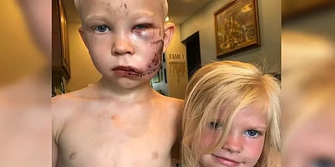 நாயிடமிருந்து தங்கையைக் காப்பாற்றிய வீரச்சிறுவனின் உடம்பில் 90 தையல்!