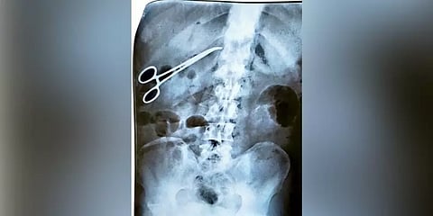 வயிற்றுக்குள் கத்தரிக்கோலை வைத்து தைத்த அரசு மருத்துவர் - கேரளாவில் நிகழ்ந்த அலட்சியம்