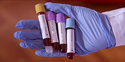 தமிழகத்தில் இன்று கொரோனா பாதிப்பு எண்ணிக்கை எவ்வளவு?: முழு விவரம்!