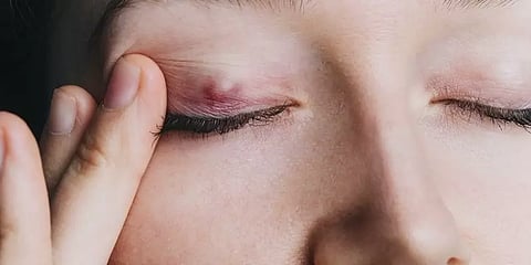 கண்ணில் தொற்று எதனால் ஏற்படுகிறது? அறிகுறிகள், சிகிச்சைகள் என்ன?