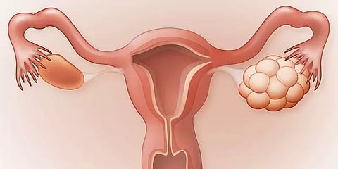 சினைப்பை நீர்க்கட்டிகள் பற்றிய தவறான தகவல்களும், உண்மையும்