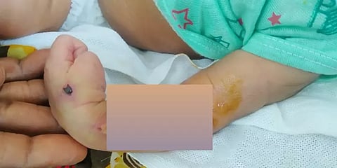 நெல்லை: தவறான சிகிச்சையால் பிறந்த குழந்தையின் கை வளைந்து பாதிப்பு - பெற்றோர் புகார்!