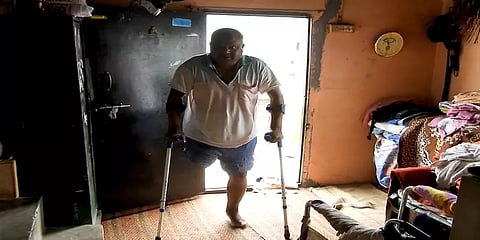 காலை இழந்து கஷ்டத்தில் வாழும் சுற்றுலா வழிகாட்டி... பயோனிக் கால்கள் வழங்க கோரிக்கை