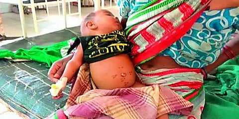 குழந்தைக்கு வயிற்று வலி: இரும்புக் கம்பியால் சூடு வைத்த மாமா!