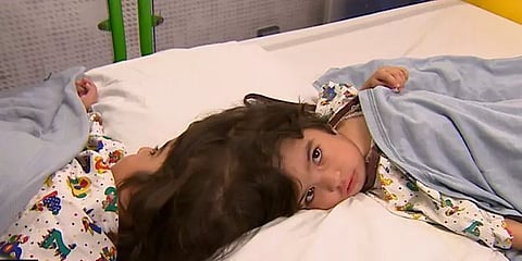 தலை ஒட்டிப் பிறந்த இரட்டை சகோதரிகள் இனி தனித்தனியே...! சந்தோஷமாக நாடு திரும்பினர்..!