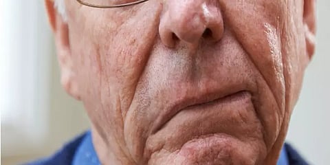 முதியோர்களை அதிகம் தாக்கும் பக்கவாதம்.... வராமல் தடுக்க மருத்துவர் ஆலோசனை!