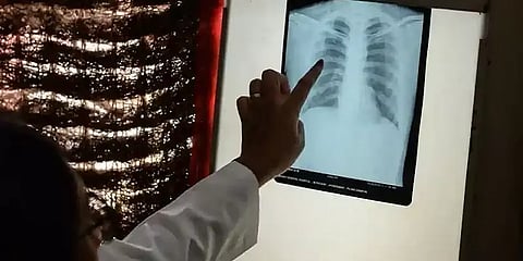 'கொரோனா சூழலால் கூடுதலாக 10 லட்சம் காசநோய் பாதிப்பு!' - எச்சரிக்கும் ஆய்வாளர்