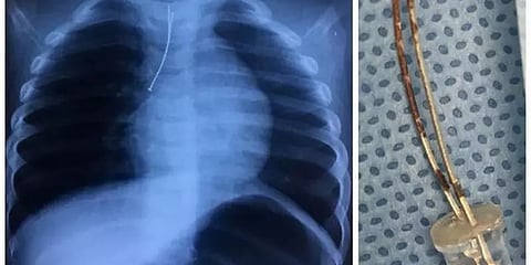 எல்.இ.டி. பல்ப்பை விழுங்கிய சிறுவன்.. அறுவை சிகிச்சை செய்து அகற்றம்..