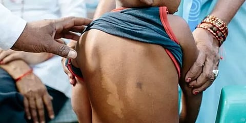 தேமல் அலட்சியம் வேண்டாம்.. இன்று உலக தொழுநோய் தினம்