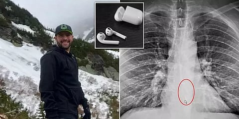 திடீர் நெஞ்சுவலி.. தூக்கத்தில் ஏர்பட்ஸை விழுங்கிய நபருக்கு நேர்ந்த விபரீதம்!