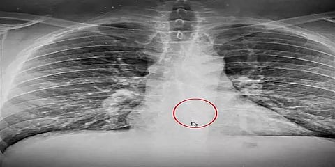 நெஞ்சு வலியினால் மருத்துவரை நாடியவருக்கு எக்ஸ்ரே கொடுத்த அதிர்ச்சி!