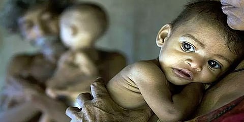 பீகாரில் 42.8% குழந்தைகளுக்கு தீவிர ஊட்டச்சத்து குறைபாடு; கர்ப்பிணிகளுக்கு ரத்தசோகை!