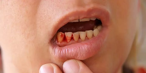 பல் ஈறுகளில் ரத்தக்கசிவுக்கு சுத்தமின்மைதான் காரணமா? - தீர்வு என்ன ?