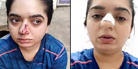 ''உணவு டெலிவரி பாய் என் மூக்கை உடைத்துவிட்டார்'' - ரத்தம் வழிய வழிய வீடியோ பதிவிட்ட பெண்!