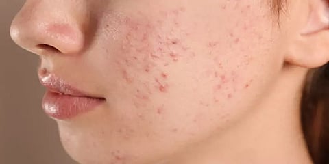 தர்பூசணி முதல் எலுமிச்சை ஜூஸ் வரை.. பருக்களை தடுக்கும் உணவுகள்!