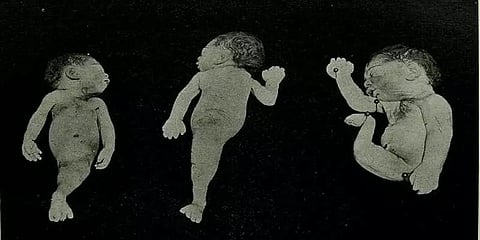 ஹைதராபாத்: கடல் கன்னியை போன்ற உடலுடன் பிறந்த குழந்தை; சில மணிகளில் உயிரிழந்த சோகம்!