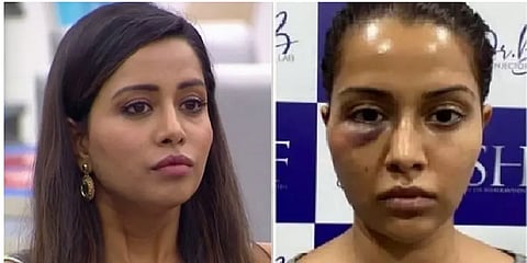 வீங்கிய முகம் - தோல் மருத்துவர் மீது புகார் அளித்த நடிகை ரைசா வில்சன்