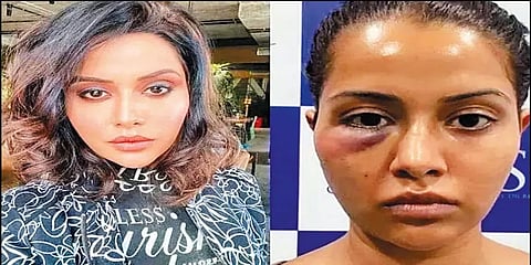 ’5கோடி இழப்பீடு கோரி வழக்கு தொடுத்துள்ளோம்’- ரைசாவுக்கு சிகிச்சை பற்றி மருத்துவர் விளக்கம்