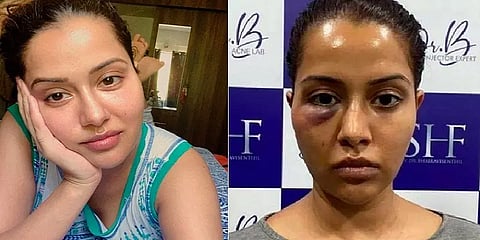 சீரான முகத்துடன் புதிய புகைப்படத்தை வெளியிட்ட ரைசா