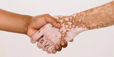 வெண்புள்ளி எனும் நிறக்குறைபாடு... தவறான புரிதல்களும் சரியான பார்வையும்!