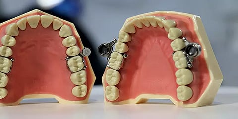 உடல் எடையைக் குறைக்க, வாய்க்கு பூட்டுபோடும் புதிய கருவி: நியூசி. ஆய்வாளர்கள் கண்டுபிடிப்பு