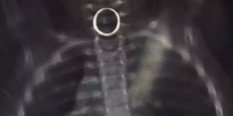 சிவகங்கை: உணவுக்குழாயில் சிக்கிய மோதிரம்; குழந்தையை காப்பாற்றிய அரசு மருத்துவர்கள்