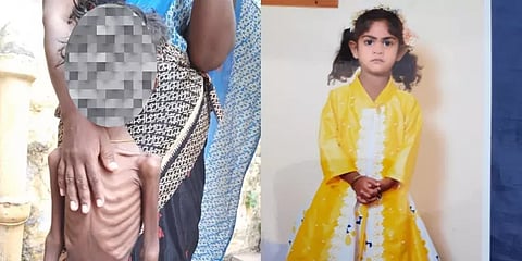 பிளிச்சிங் பவுடர் சாப்பிட்டதால் எலும்பும் தோலுமாக பரிதாப நிலையில் தென்காசி சிறுமி