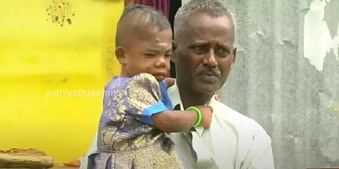 25 வயதாகியும் 2 வயது குழந்தை போல இருக்கும் பெண்.. தாயாக கவனித்து கொள்ளும் தந்தை!