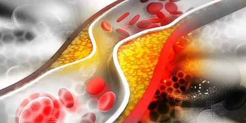 உடலில் சேரும் கொழுப்புச்சத்தின் வகைகள்... எந்தக் கொழுப்பு ஆபத்தானது - நிபுணர் விளக்கம்