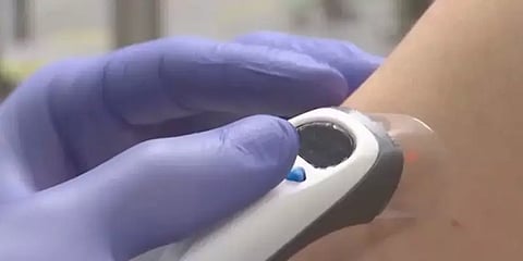 வலி இல்லாமல் ஊசி இல்லாமல் மருந்தை செலுத்தும் லேசர் தொழில்நுட்பம் கண்டுபிடிப்பு