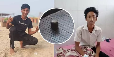 சென்னை: சவ ஊர்வலத்தில் வெடி வெடித்தபோது பறிபோன சிறுவனின் கண் பார்வை