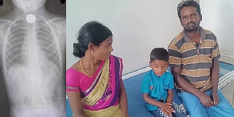 அரூர்: நாணயத்தை விழுங்கிய குழந்தை; ஐந்தே நிமிடத்தில் அப்புறப்படுத்திய அரசு மருத்துவர்கள்