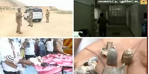 புதுக்கோட்டை: 4 மணி நேர அறுவை சிகிச்சைக்கு பின் சிறுவன் தலையிலிருந்த குண்டு அகற்றம்