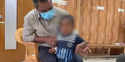 குழந்தையின் வாய் வழியே குத்தி முதுகு வழியே வெளிவந்த கம்பி - 45 நிமிடத்தில் அகற்றி சாதனை