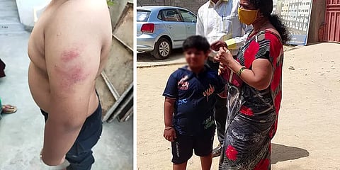 வீட்டுப்பாடம் செய்யவில்லை எனக் கூறி யுகேஜி மாணவனுக்கு சரமாரி பிரம்பு அடி - ஆசிரியை நீக்கம்