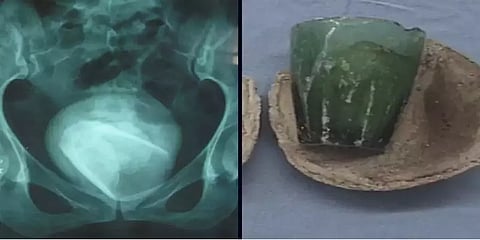 4 வருடங்களாக பெண்ணின் சிறுநீர்ப்பையில் இருந்த கண்ணாடி டம்ளர்! ஷாக் ஆன மருத்துவர்கள்