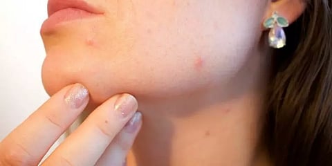 கோடை வந்தாச்சு! முகப்பருவிலிருந்து பாதுகாக்கும் இந்த உணவுகளை சேர்த்துக்கோங்க!