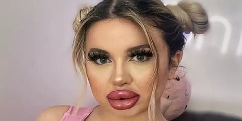 மனித பார்பியாக மாற 70 ஆயிரம் டாலர் செலவில் அறுவைசிகிச்சைகள் - உறவுகளை உதறித்தள்ளிய பெண்!