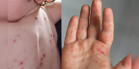 கேரளாவில் புதிதாக பரவும் தக்காளி காய்ச்சல்! 85 குழந்தைகள் பாதிப்பு