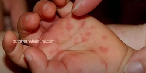 குழந்தைகளை பாதிக்கும் தக்காளி காய்ச்சல் - எப்போது மருத்துவரை அணுகவேண்டும்? - ஓர் பார்வை