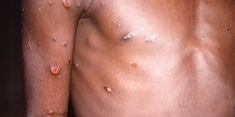 பாலியல் உறவால் அதிகம் பரவும் மன்ங்கிபாக்ஸ் - உறுதிசெய்யும் 5 தரவுகள்