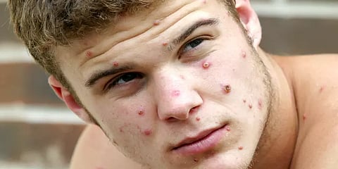 12 நாடுகளில் பரவிய குரங்கு அம்மை - அமெரிக்க அதிபர் ஜோ பைடன் கவலை