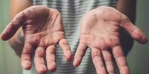 கொரோனா வைரஸ் போல் ஆபத்தானதா குரங்கு வைரஸ்? - அமெரிக்க மருத்துவர் விளக்கம்